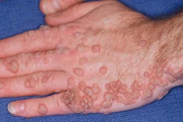 Bradavice i kako ih odstraniti prirodnim lekom